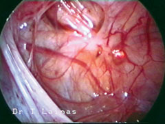 Peritoneal endometriosis (atypical laparoscopic appearance): red flame-like lesions.  